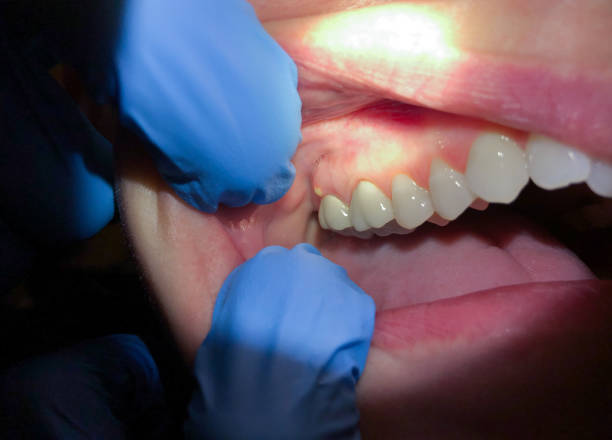 Best Emergency Care for Gum Disease in Spring Valley, CA